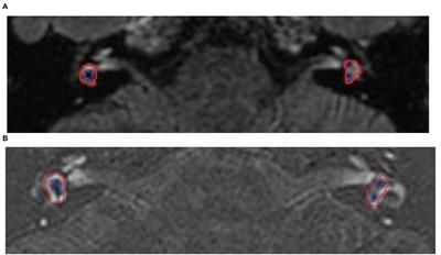 Imaging Analysis of Patients With Meniere's Disease Treated With Endolymphatic Sac-Mastoid Shunt Surgery